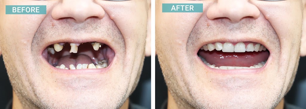 Dental Implants