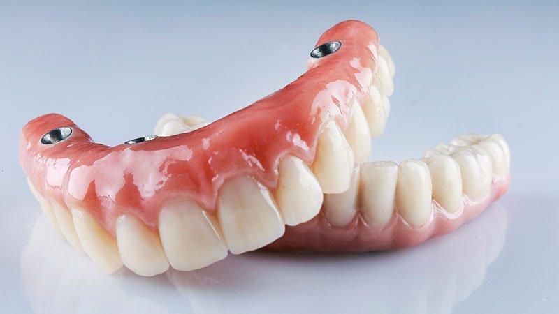 dental-implans.jpg